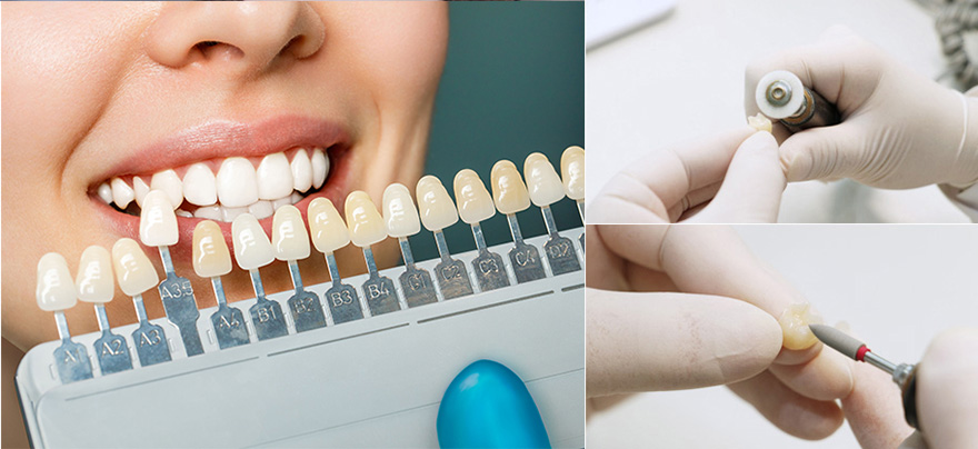 排齦、備牙、倒凹、調整咬合…為了讓修復體使用更久、更美觀，堅決杜絕毫厘偏差！